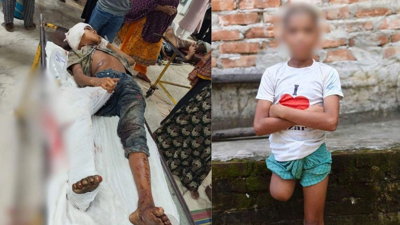 Raihan’s leg was amputated after he was injured in a train accident